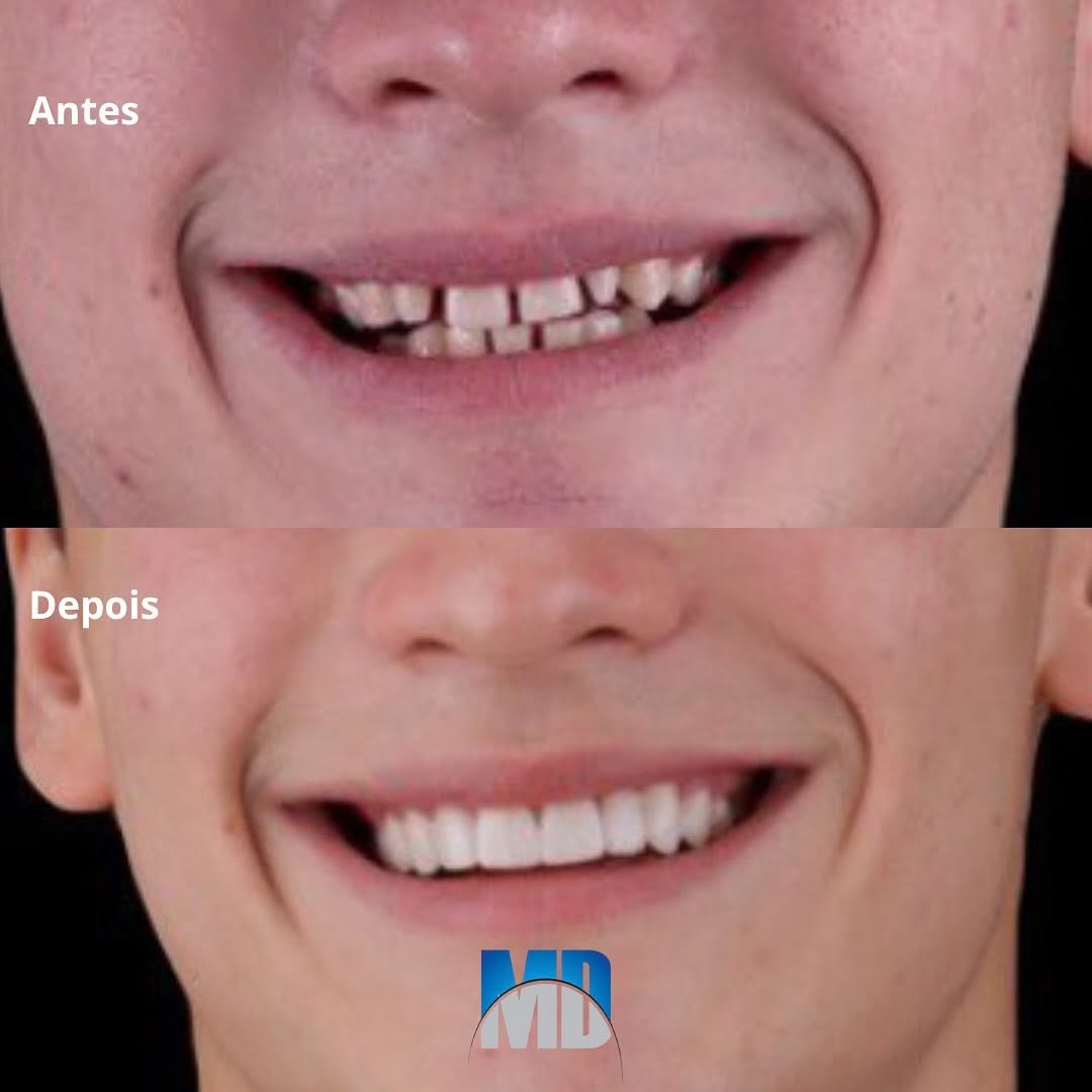 Reabilitação oral completa com implantes e próteses