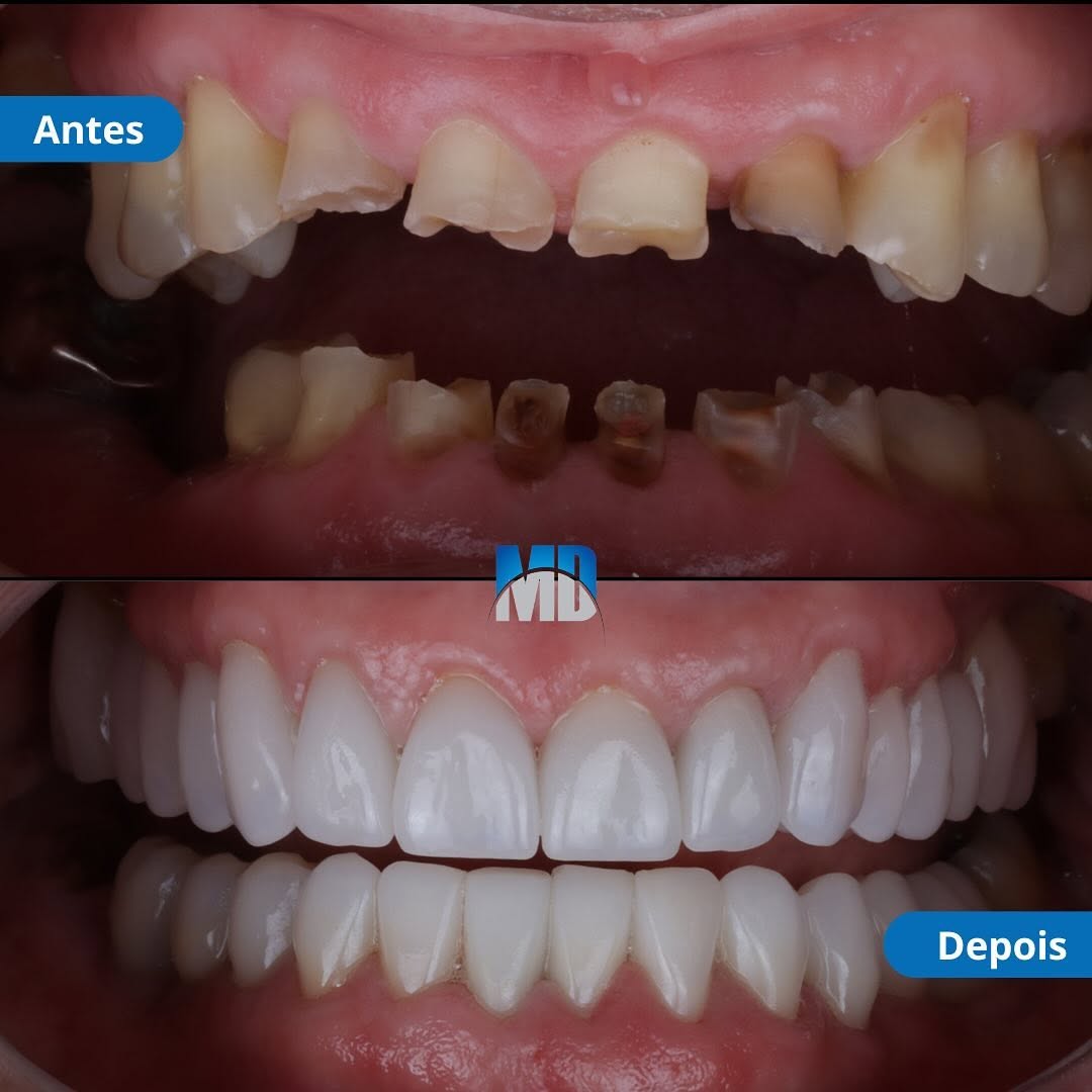 Aumento de coroa e facetas em porcelana