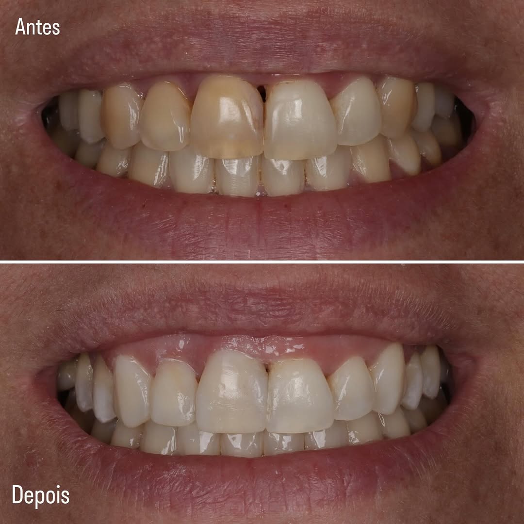 Correção de sorriso gengival e alinhamento