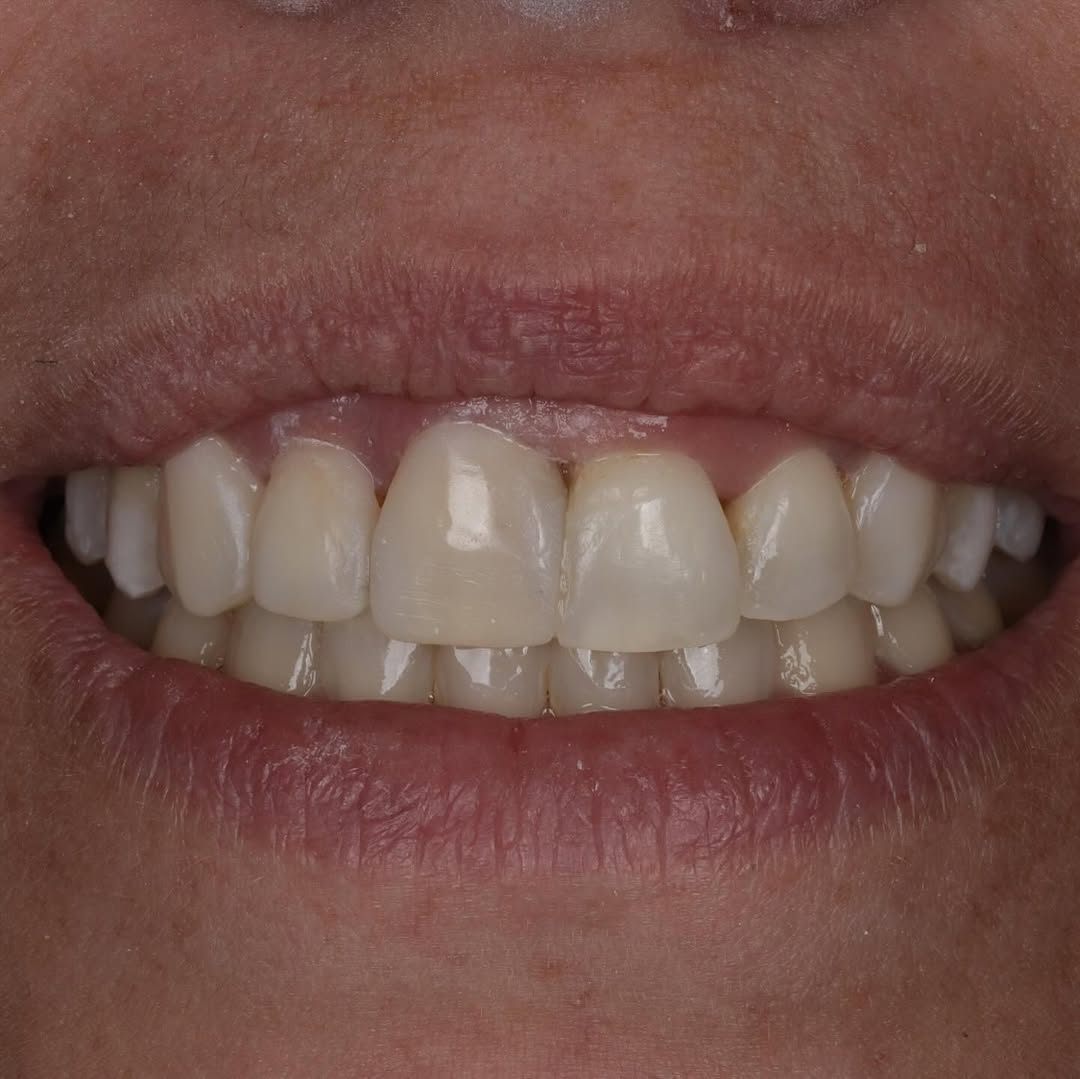 Restauração de estética e função mastigatória