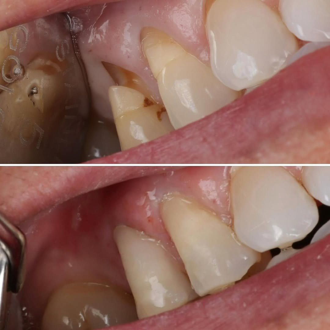 Transformação estética com lentes de contato dental